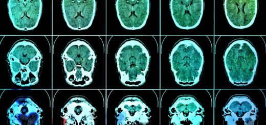 Gehirn Tomographie
